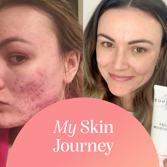 my skin journey - morgan from bohemian skin opens up about the struggles she had with acne - before and after photos skin - acne before and after